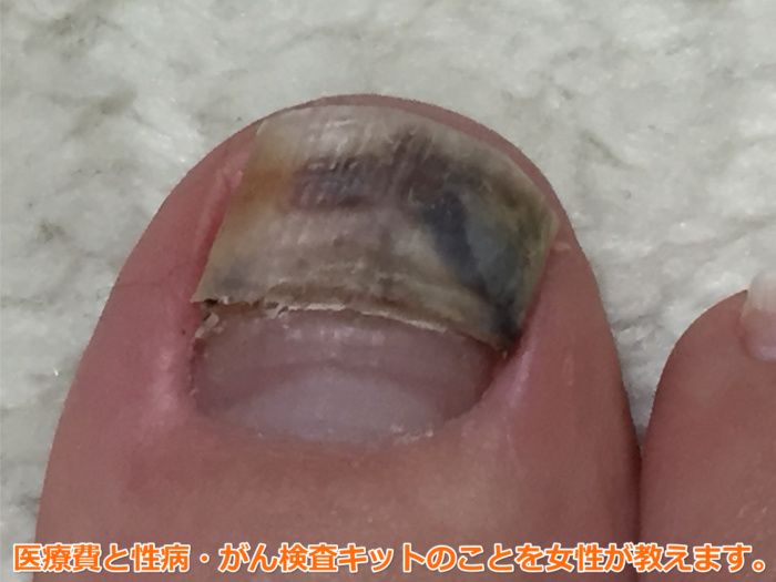 黒い足の爪の見通し