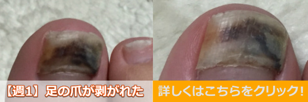 足爪剥がれる痛くない黒い内出血処置テープガーゼバナー1