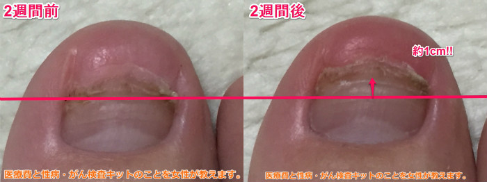 足の爪が剥がれた 56日目 新しい爪を画像で比較 2週間で1cm伸びた 健康保険や高額療養費 病院医療費を女性がわかりやすく説明します