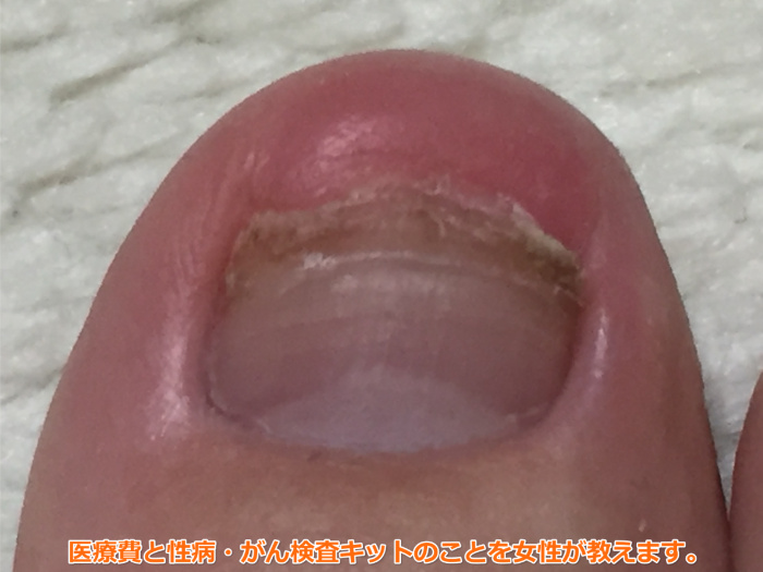 足爪剥がれる痛くない黒い内出血8週間後1